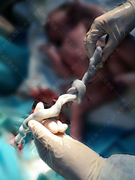 胎兒太調皮，竟在媽媽肚子里面將臍帶打了個結！