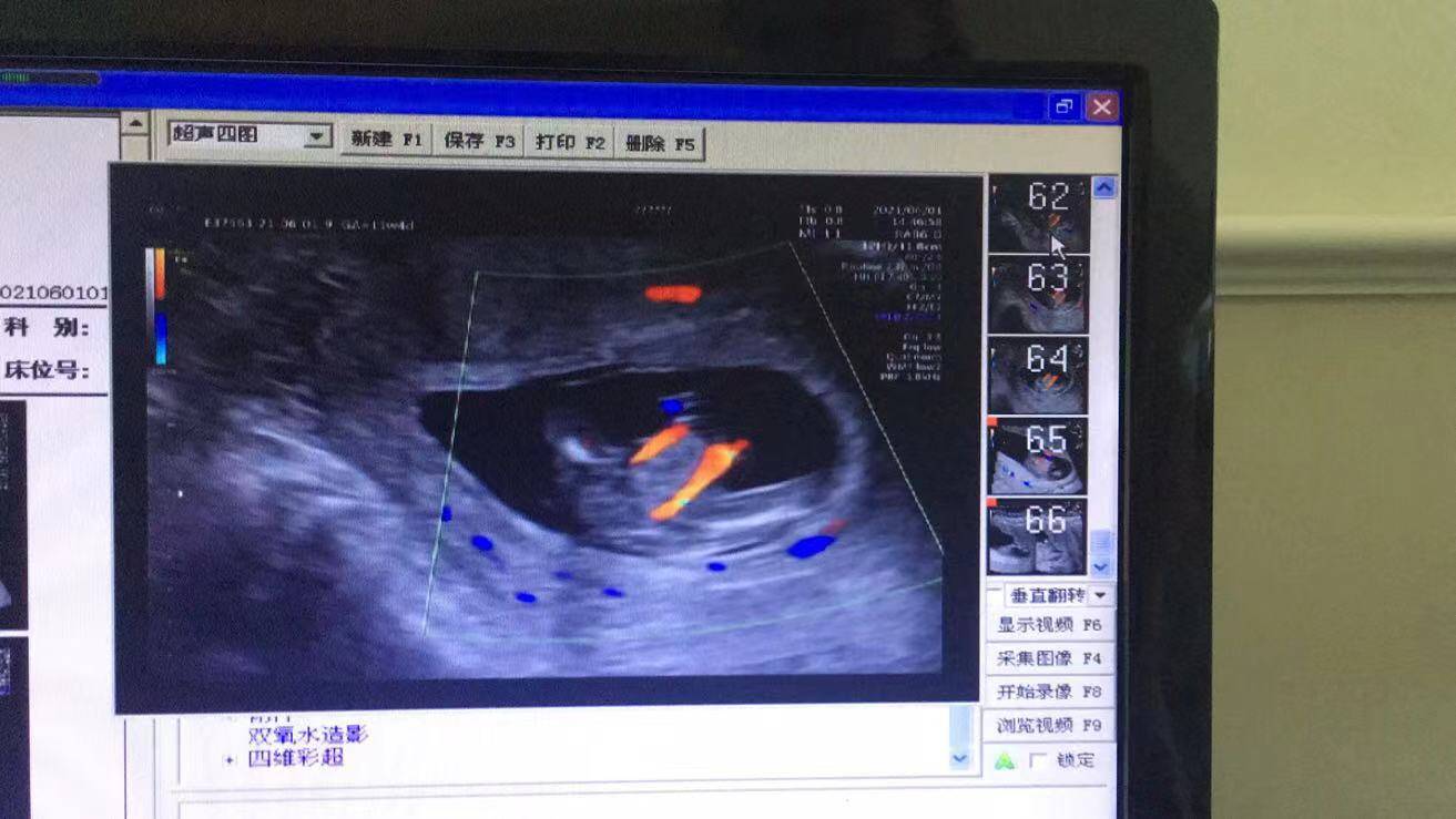 NT篩查出胎兒多發(fā)畸形，準(zhǔn)媽媽無奈終止妊娠